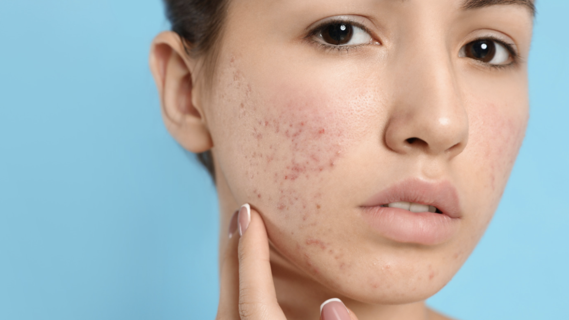 High-Demand Acne Treatment Appointment in Arlington, Virginia